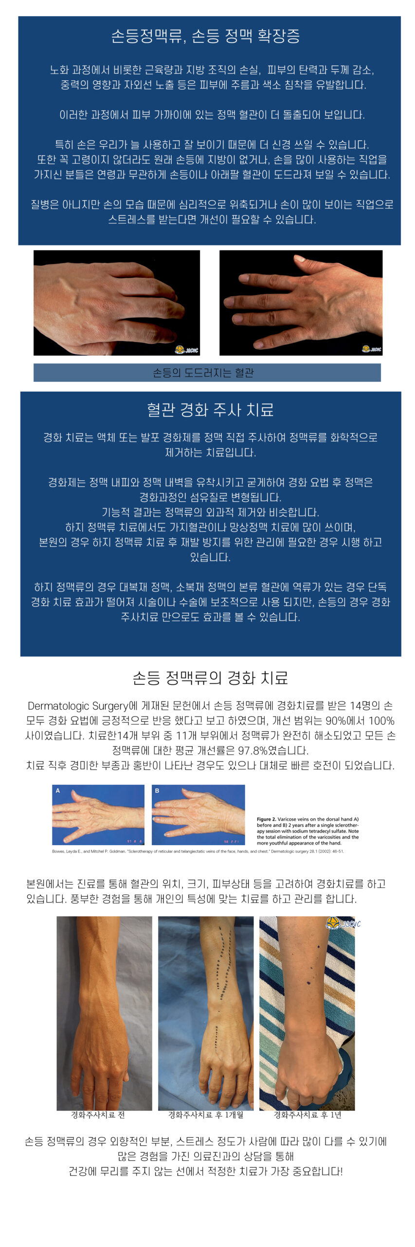 손등정맥류